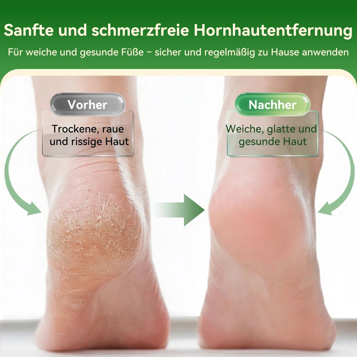 SHORAN Callus Remover, Electric Strong, Extreme Callus Removal, Rechargeable, Professional Electric Callus Remover, Foot Callus Remover for Foot Care