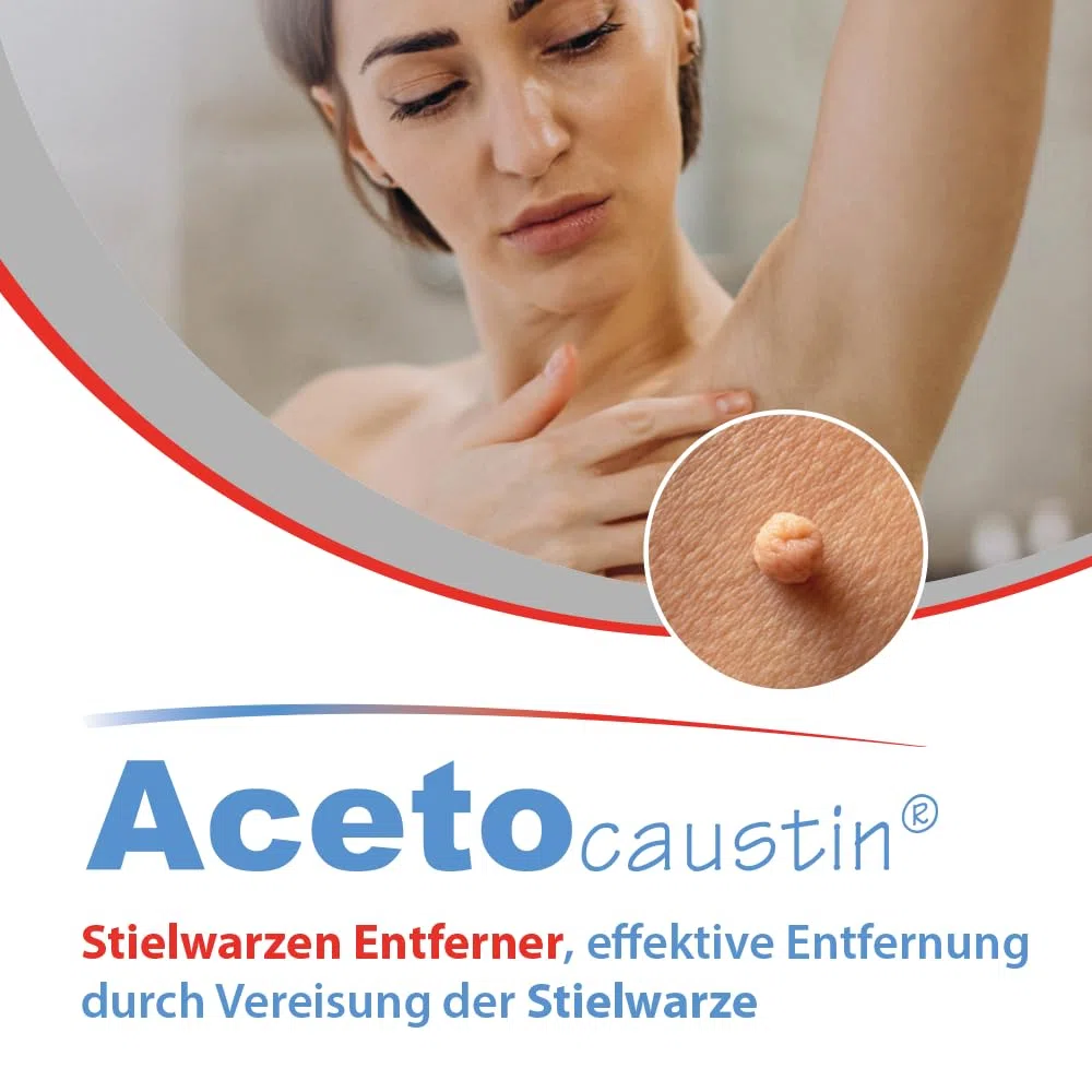Acetocaustin Stielwarzen Entferner | Entfernt Stielwarzen | Entfernung durch Vereisung der Stielwarze | 12 Anwendungen | 50ml