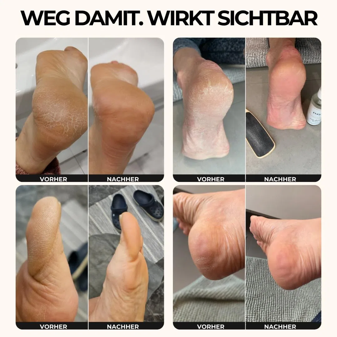 tvey" weg damit: Hornhautentferner Spray mit Soforteffekt - Mittel gegen Hornhaut und trockene Haut - mit extra viel Urea für weiche Füße - Hornhautweicher Made in Germany 100ml Vegan